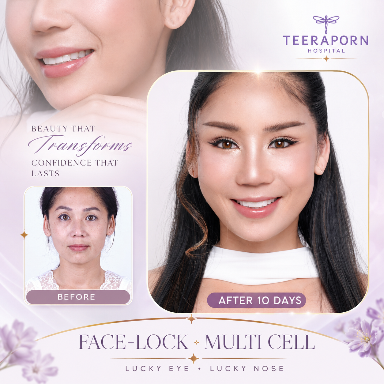 รีวิว Face-Lock ร่วมกับ Multi Cell หลัง 10 วัน โรงพยาบาลธีรพร