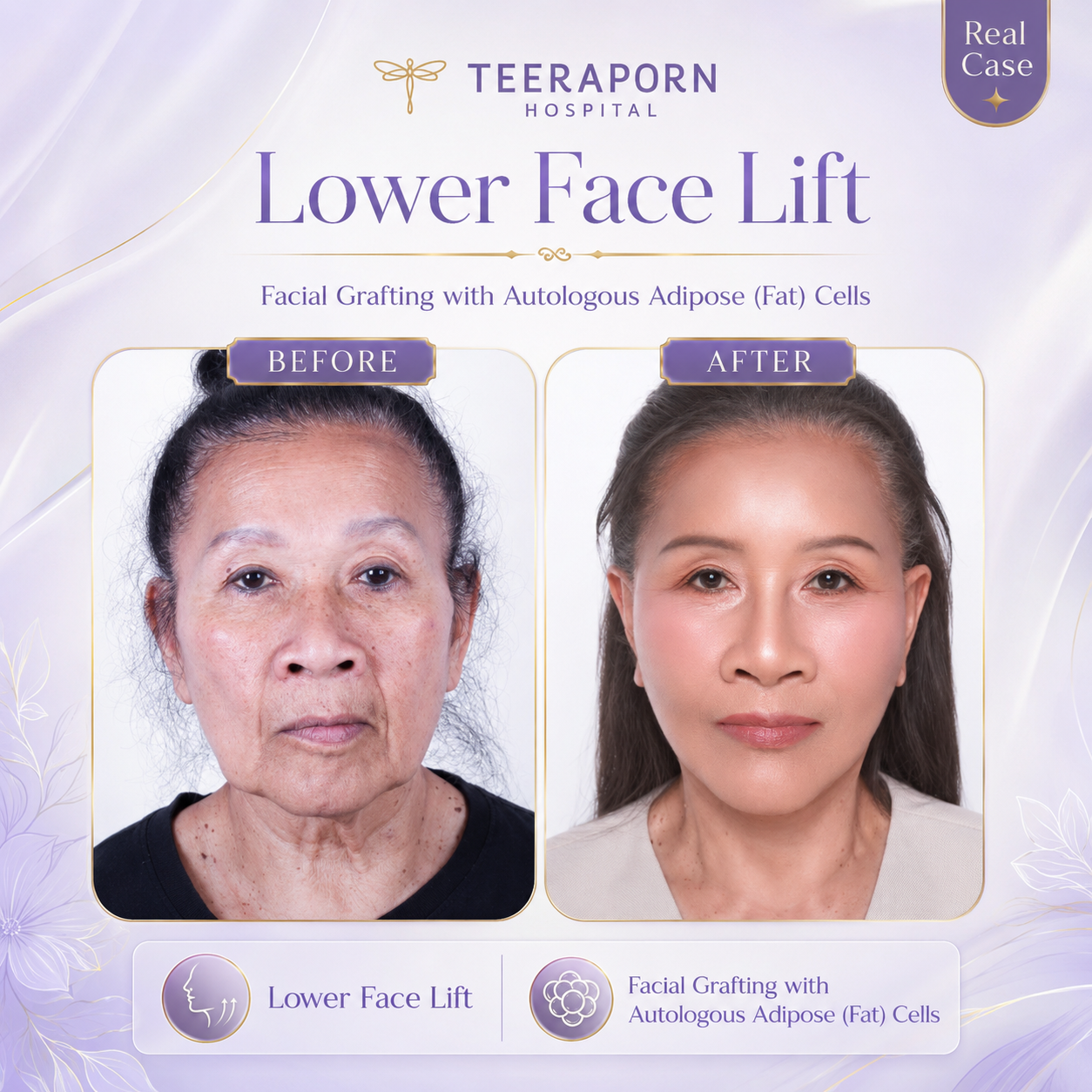 รีวิว Lower Face Lift ร่วมกับเติมไขมันใบหน้า โรงพยาบาลธีรพร