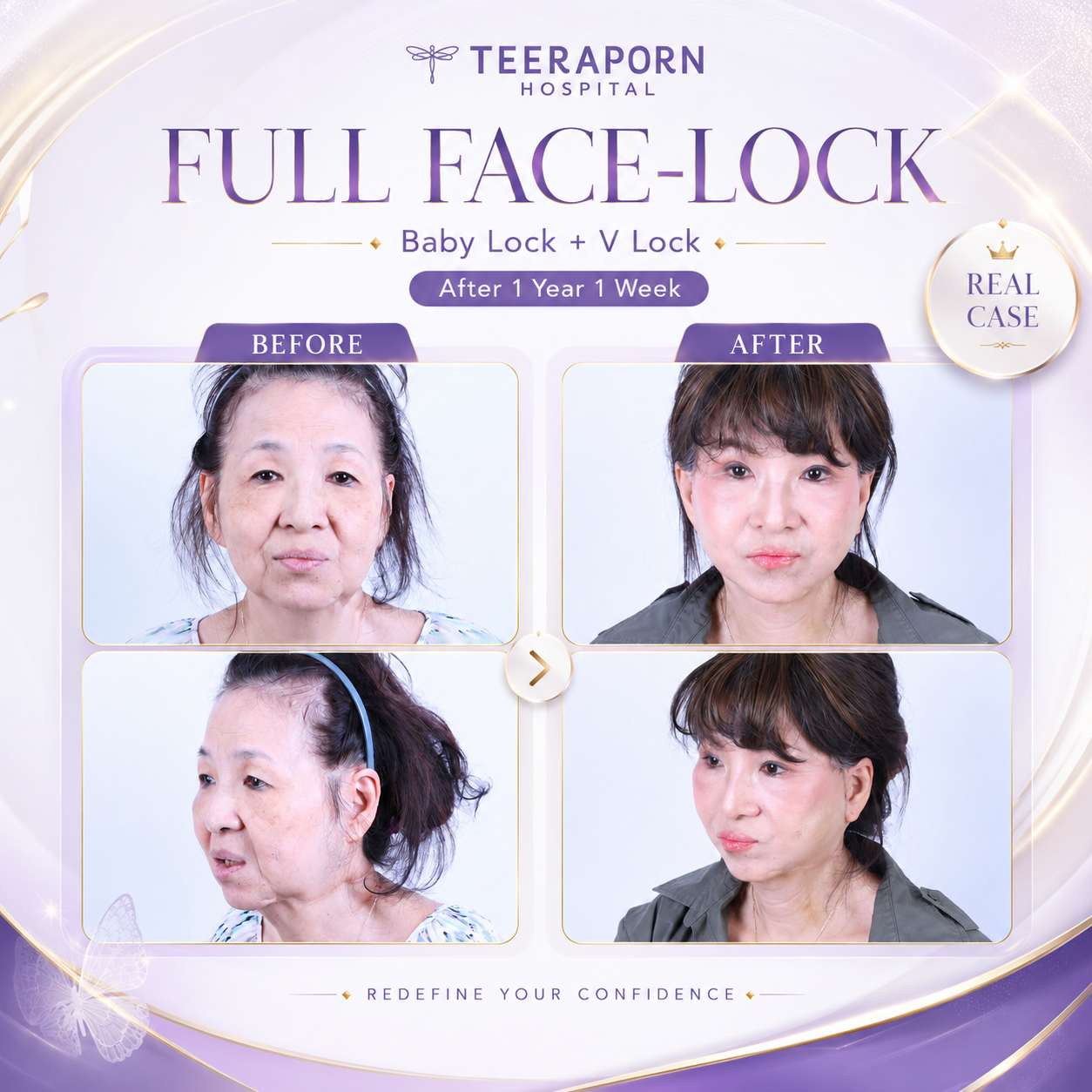 รีวิว Full Face-Lock Baby Lock และ V Lock หลังทำ 1 ปี 1 สัปดาห์ โรงพยาบาลธีรพร
