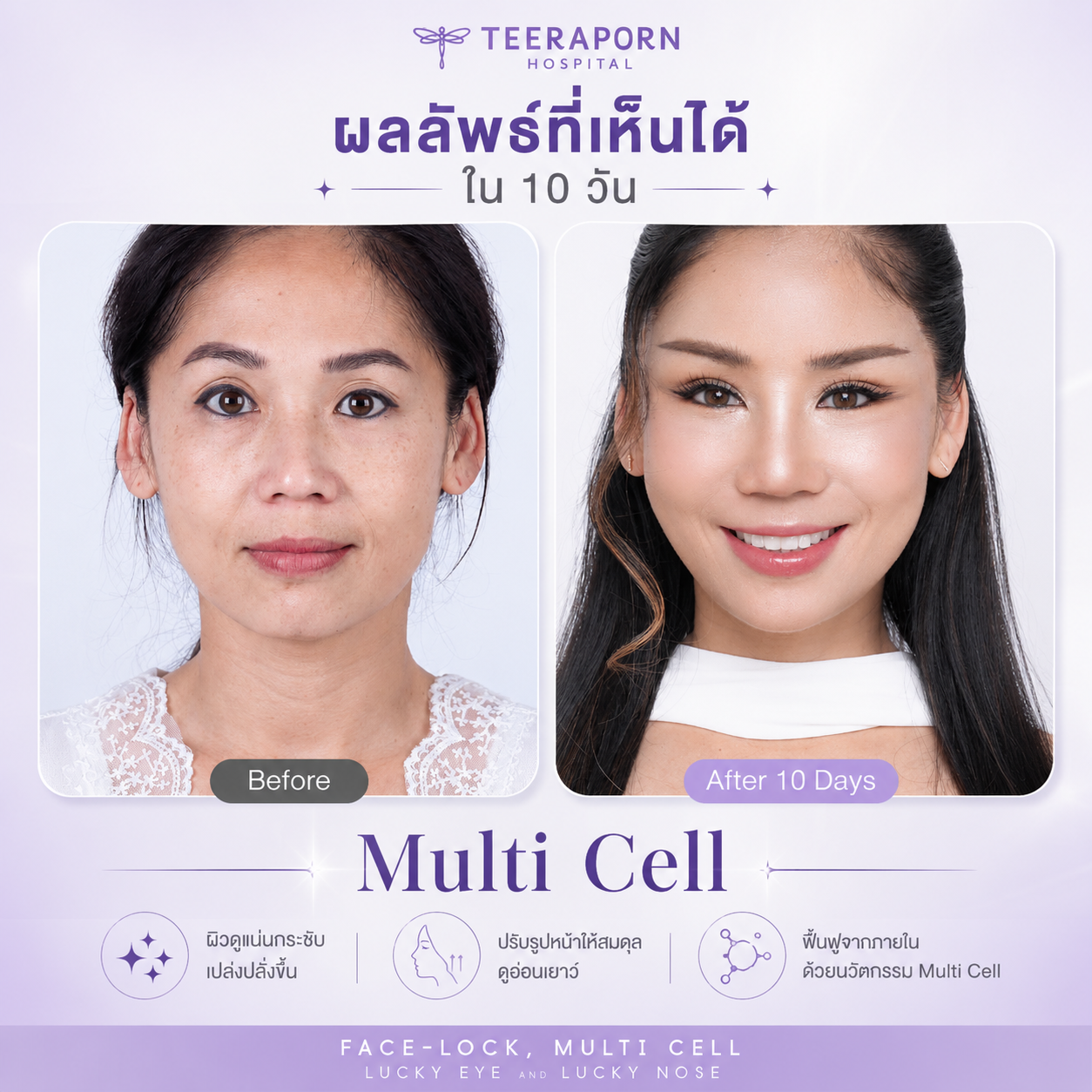 ผลลัพธ์ Multi Cell ใน 10 วัน ช่วยให้ผิวดูแน่น กระชับ และใบหน้าดูอ่อนเยาว์ขึ้น โรงพยาบาลธีรพร