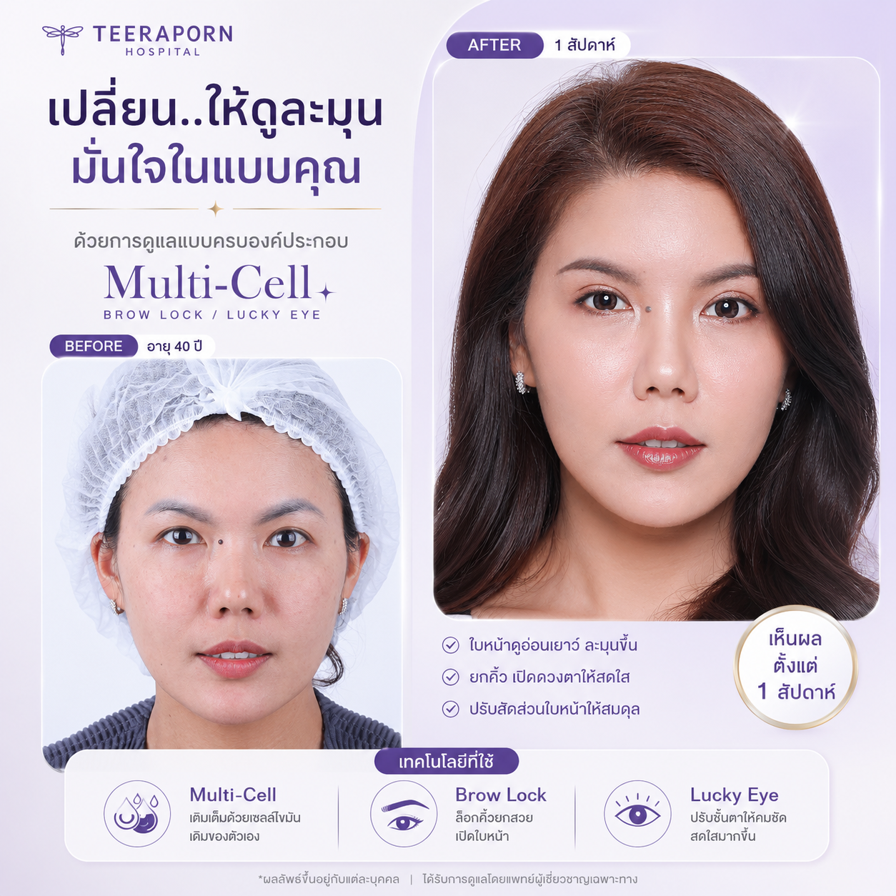 ผลลัพธ์ Multi Cell หลัง 1 สัปดาห์ ช่วยให้ใบหน้าดูละมุน สมดุล และอ่อนเยาว์ขึ้น โรงพยาบาลธีรพร