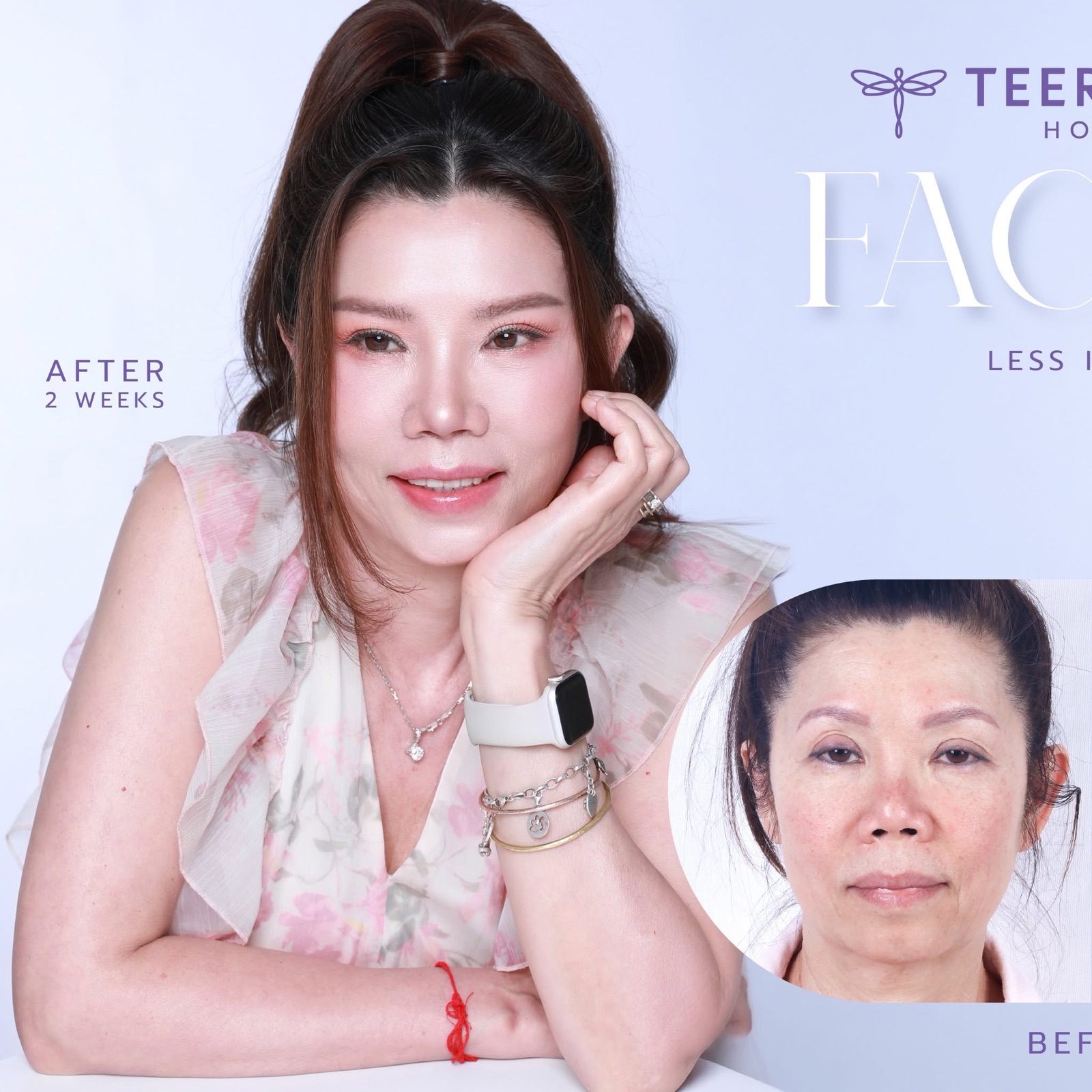 เคสดึงหน้า Face Lock หลังทำ 2 สัปดาห์ โรงพยาบาลธีรพร