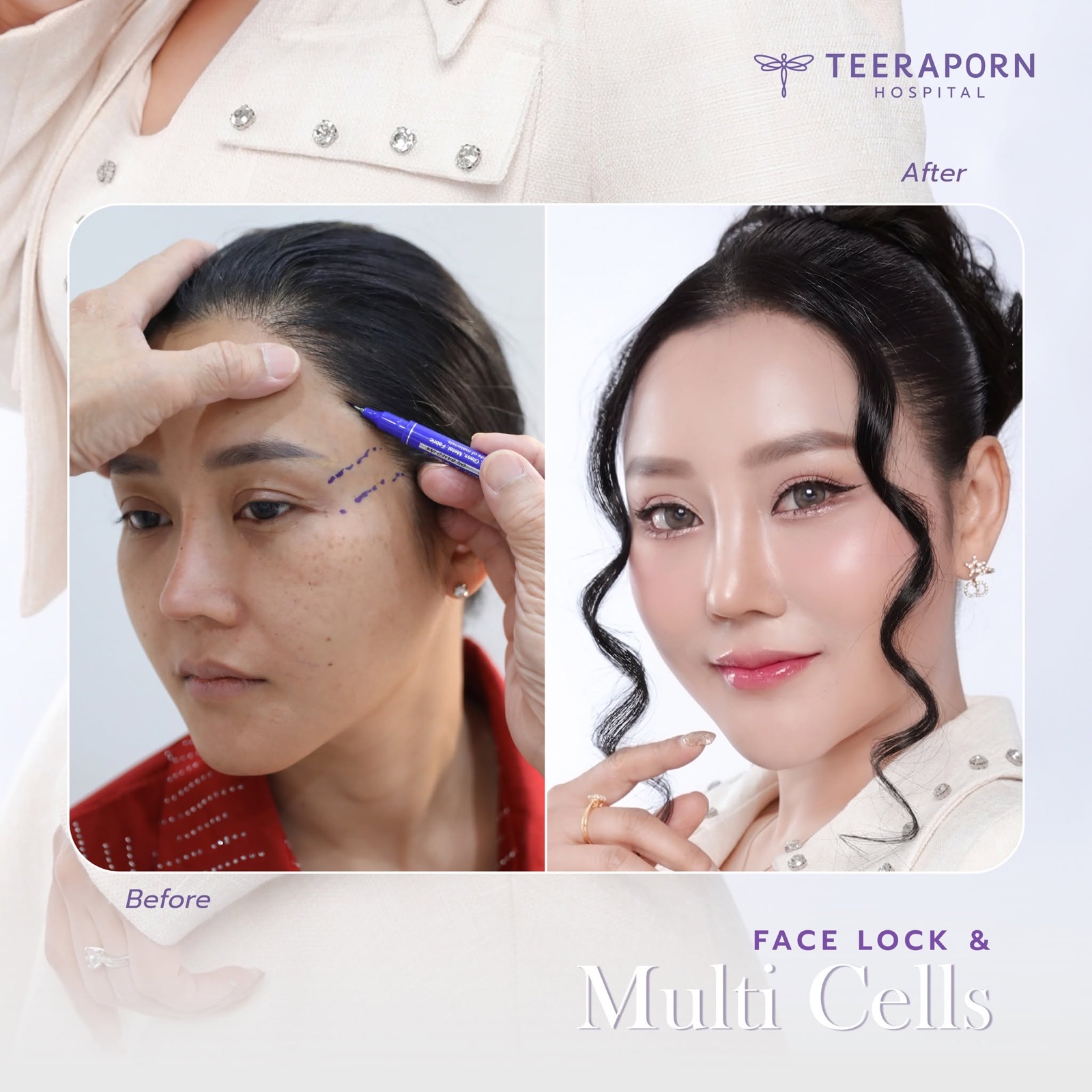 เคส Face Lock ร่วมกับ Multi Cells ก่อนและหลังทำที่โรงพยาบาลธีรพร