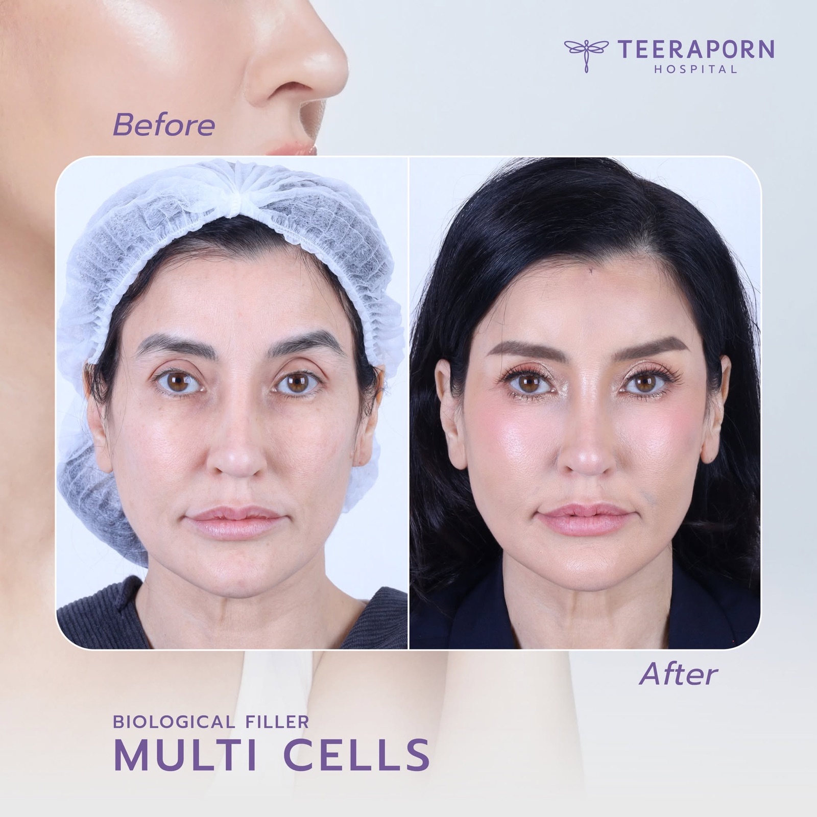 เคส Multi Cell Biological Filler ก่อนและหลังทำที่โรงพยาบาลธีรพร
