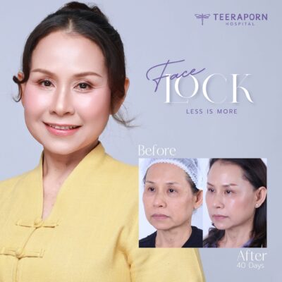 ตัวอย่างรีวิว Face Lock สำหรับผู้สนใจดึงหน้าอายุเท่าไหร่ โรงพยาบาลธีรพร