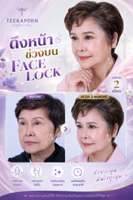 รีวิวแม่ปุ๊ ดึงหน้าช่วงบน Face Lock โรงพยาบาลธีรพร หลังทำ 2 เดือน