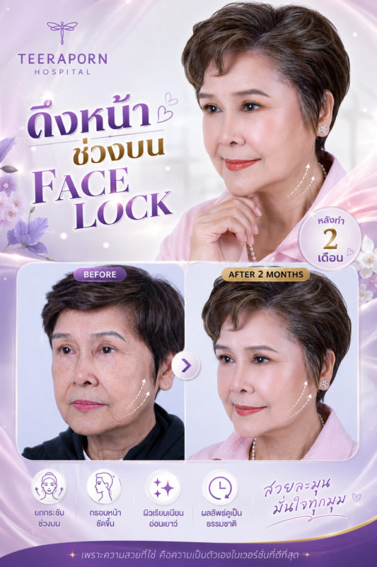 รีวิวแม่ปุ๊ ดึงหน้าช่วงบน Face Lock โรงพยาบาลธีรพร หลังทำ 2 เดือน