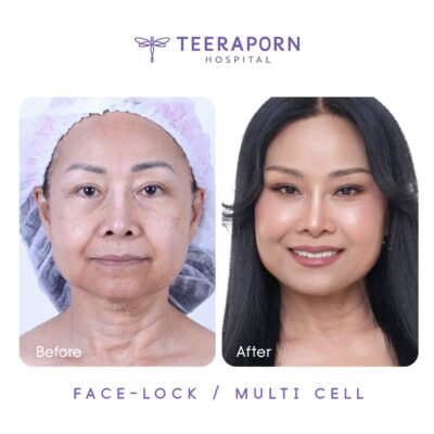 ตัวอย่างผลลัพธ์ Face Lock และ Multi Cell โรงพยาบาลธีรพร