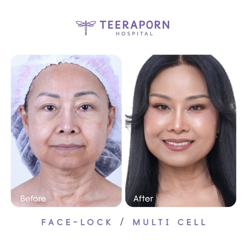 ตัวอย่างผลลัพธ์ Face Lock และ Multi Cell โรงพยาบาลธีรพร
