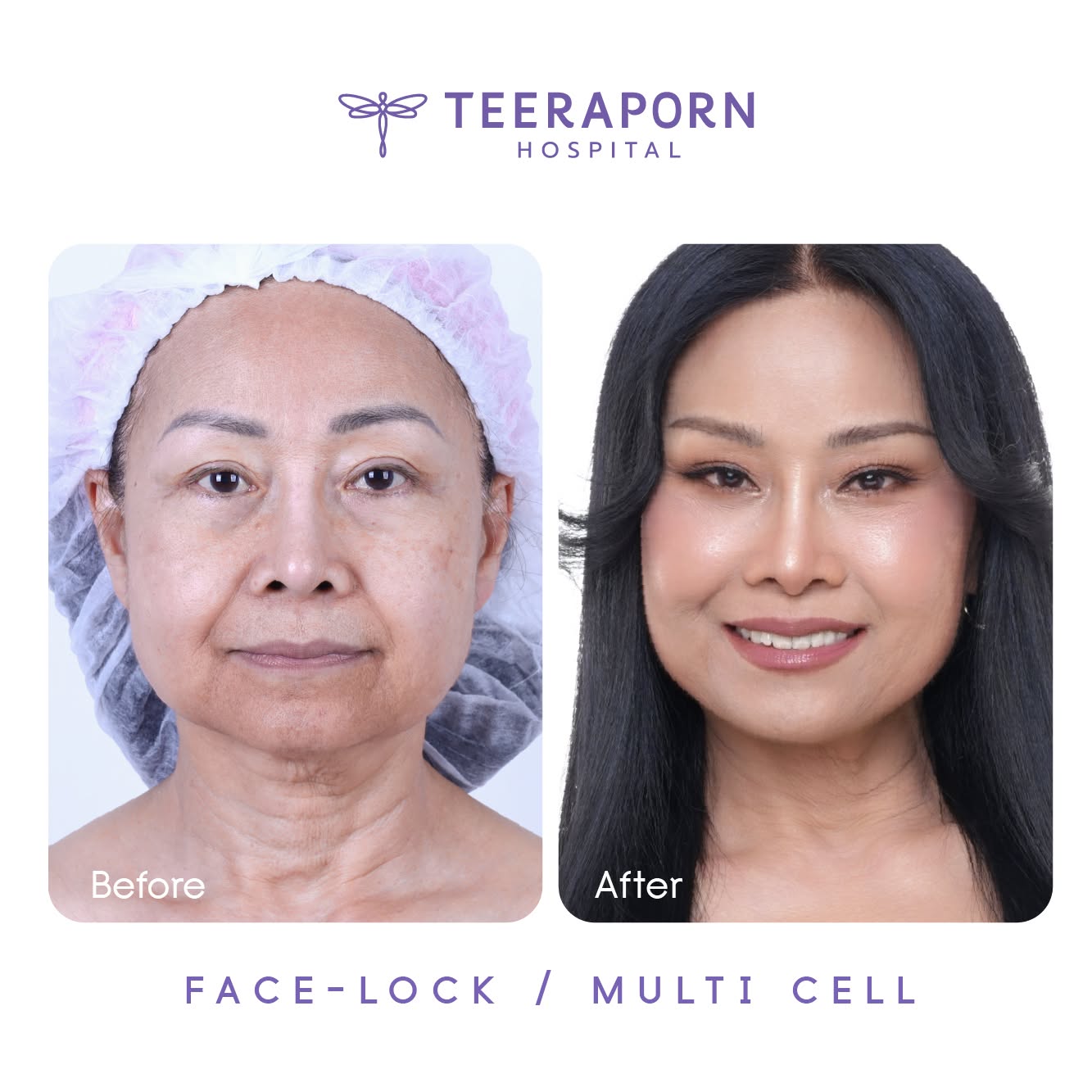 ตัวอย่างผลลัพธ์ Face Lock และ Multi Cell โรงพยาบาลธีรพร