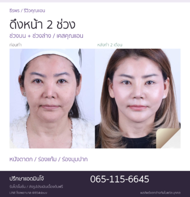 รีวิวดึงหน้า 2 ช่วง คุณแอน เปรียบเทียบภาพก่อนทำและหลังทำ 2 เดือนที่ธีรพร