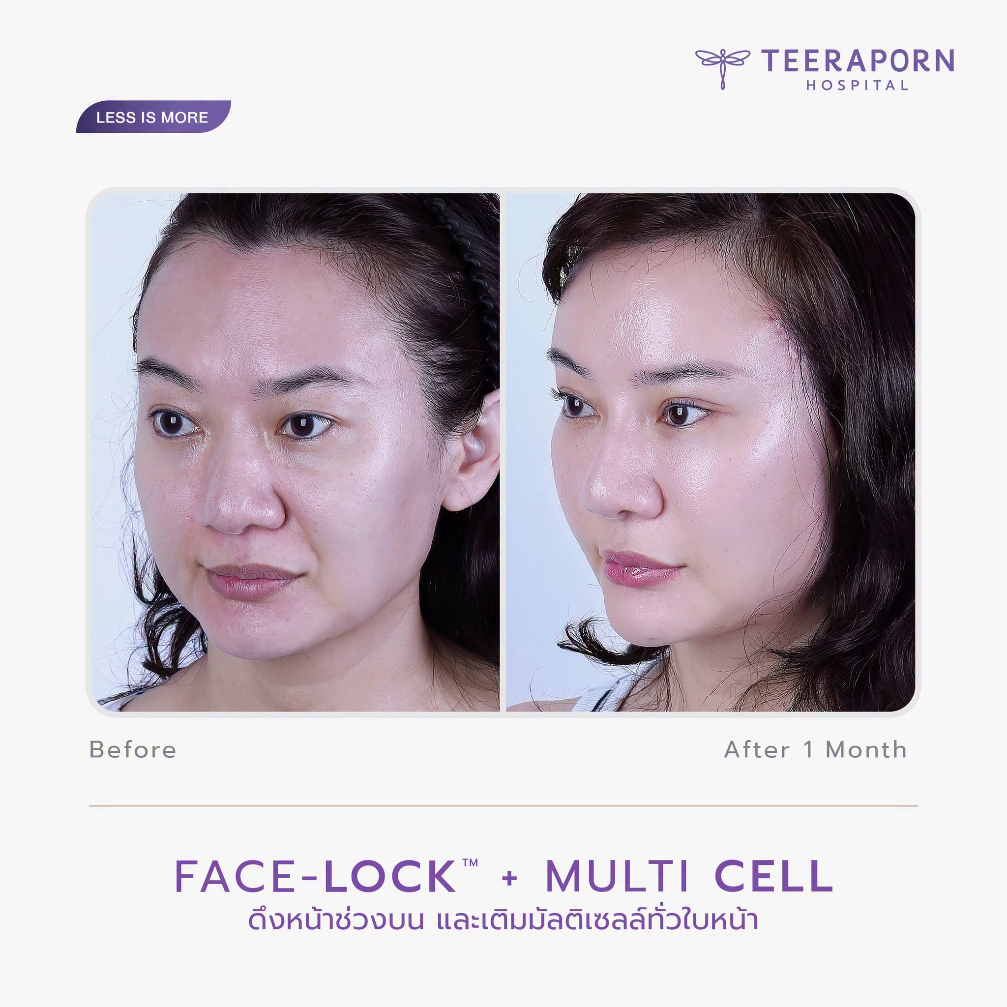 รีวิว Face Lock ช่วงบนร่วมกับ Multi Cell ก่อนทำและหลังครบ 1 เดือน มุมเฉียง โรงพยาบาลธีรพร