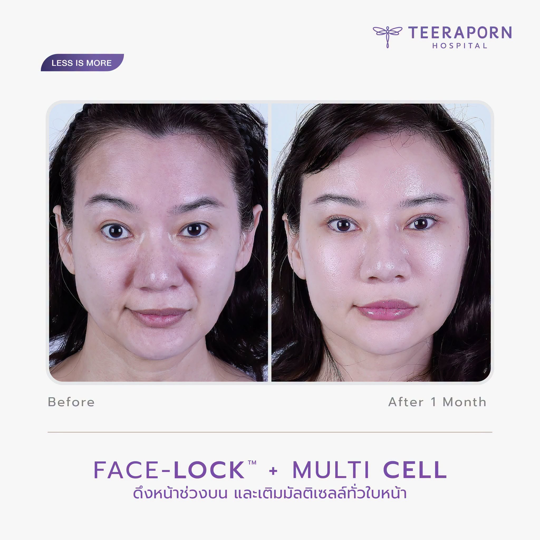 รีวิว Face Lock ช่วงบนร่วมกับ Multi Cell ก่อนทำและหลังครบ 1 เดือน มุมหน้าตรง โรงพยาบาลธีรพร