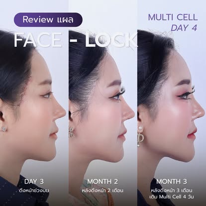 รีวิวจาก Facebook เพจธีรพร แสดงไทม์ไลน์ Face Lock และ Multi Cell