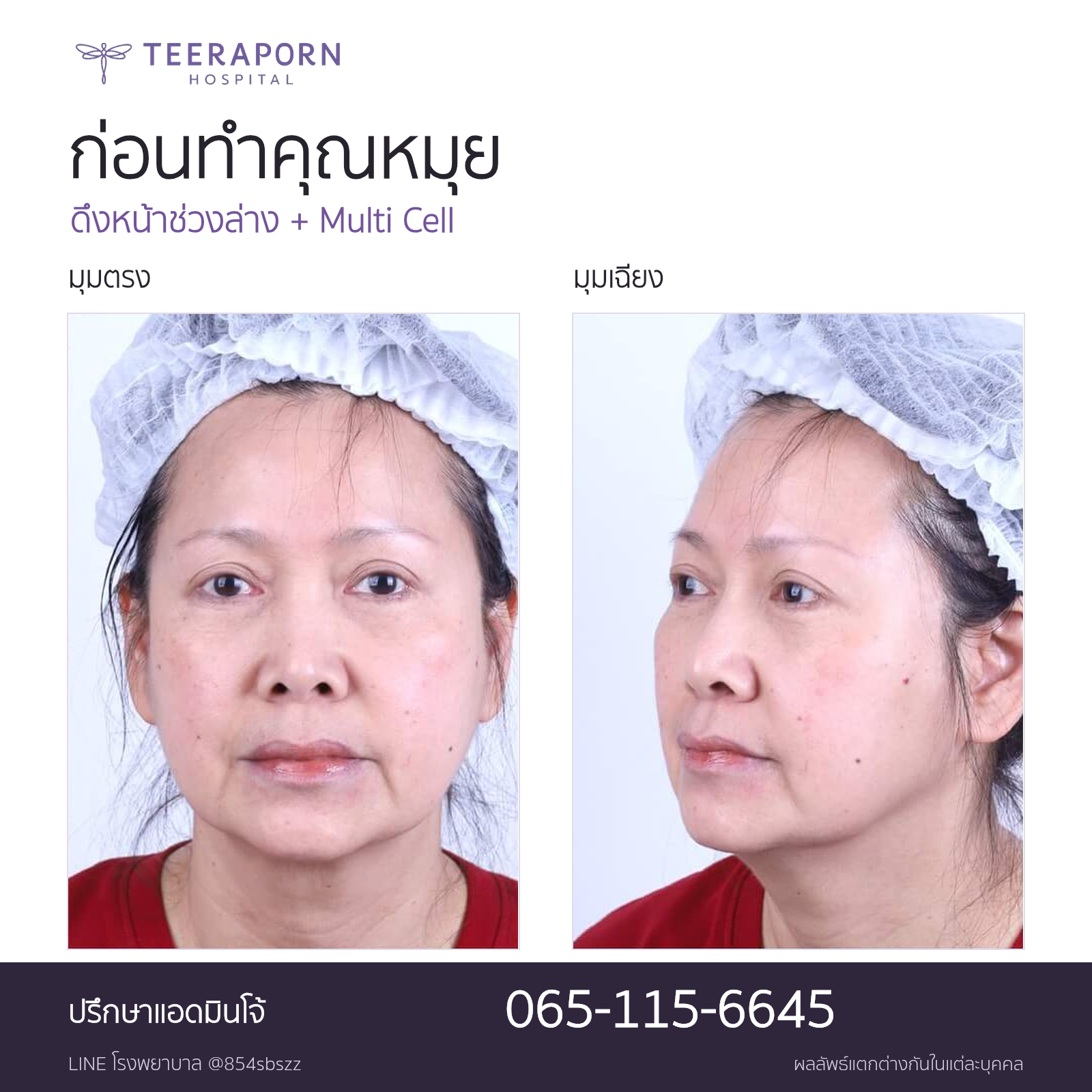 ภาพก่อนดึงหน้าช่วงล่างและ Multi Cell ของคุณหมุย มุมตรงและมุมเฉียงจากรีวิวธีรพร