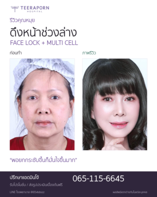 คุณหมุยก่อนทำเทียบภาพรีวิว ดึงหน้าช่วงล่างร่วมกับ Multi Cell ที่ธีรพร