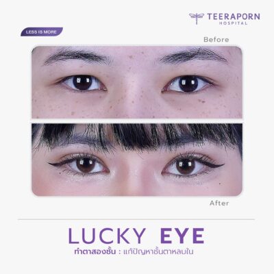 รีวิวทำตาสองชั้น Lucky Eye สำหรับชั้นตาหลบใน ภาพก่อนและหลังจากเพจโรงพยาบาลธีรพร