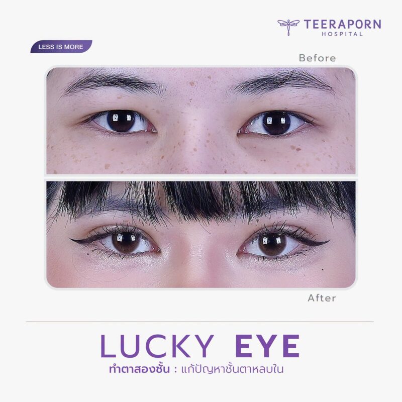 รีวิวทำตาสองชั้น Lucky Eye สำหรับชั้นตาหลบใน ภาพก่อนและหลังจากเพจโรงพยาบาลธีรพร