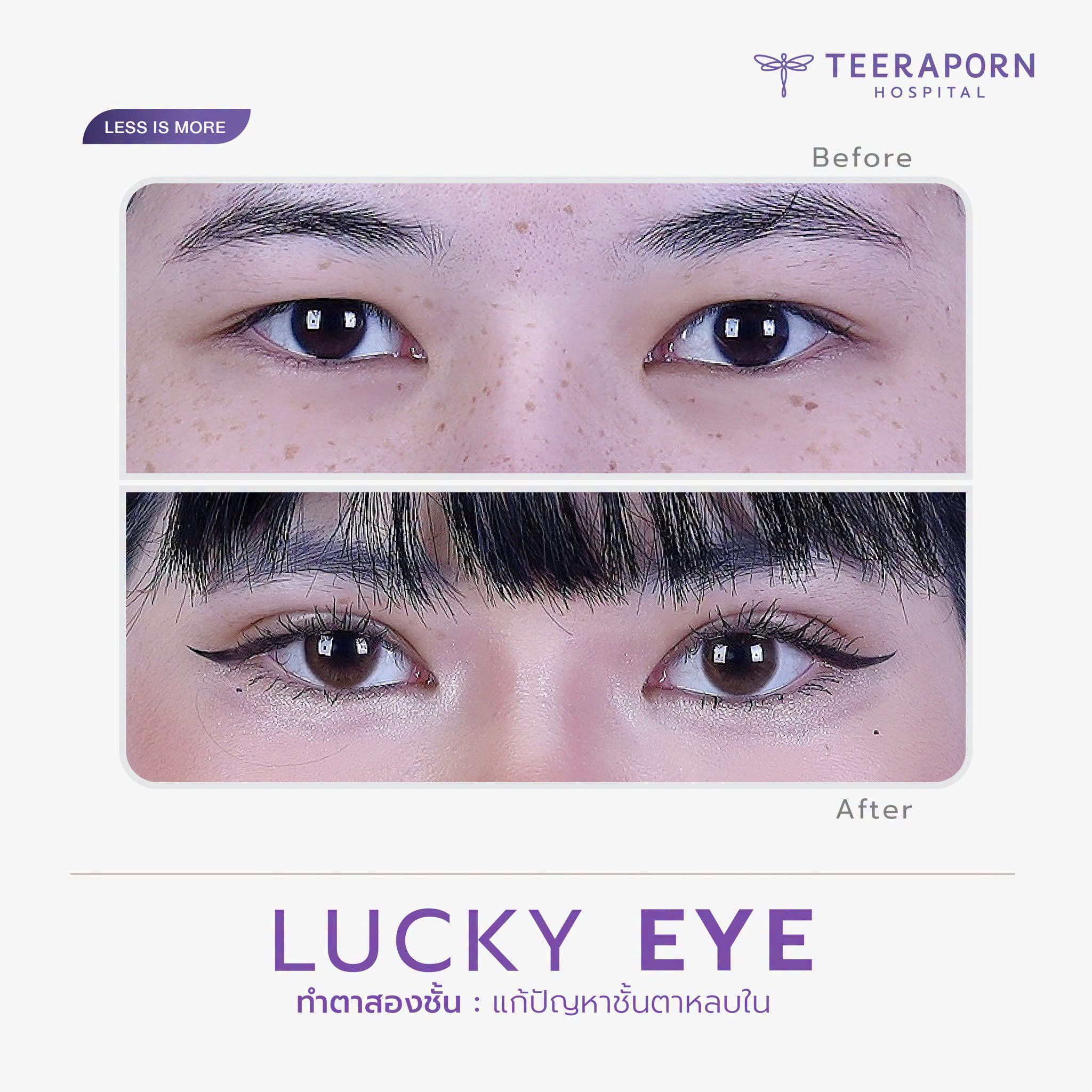รีวิวทำตาสองชั้น Lucky Eye สำหรับชั้นตาหลบใน ภาพก่อนและหลังจากเพจโรงพยาบาลธีรพร