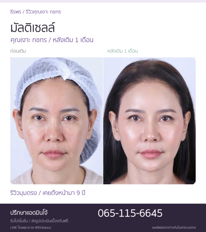 รีวิว Multi Cell คุณเงาะ กชกร ภาพก่อนเติมและหลังเติม 1 เดือน มุมตรงที่ธีรพร