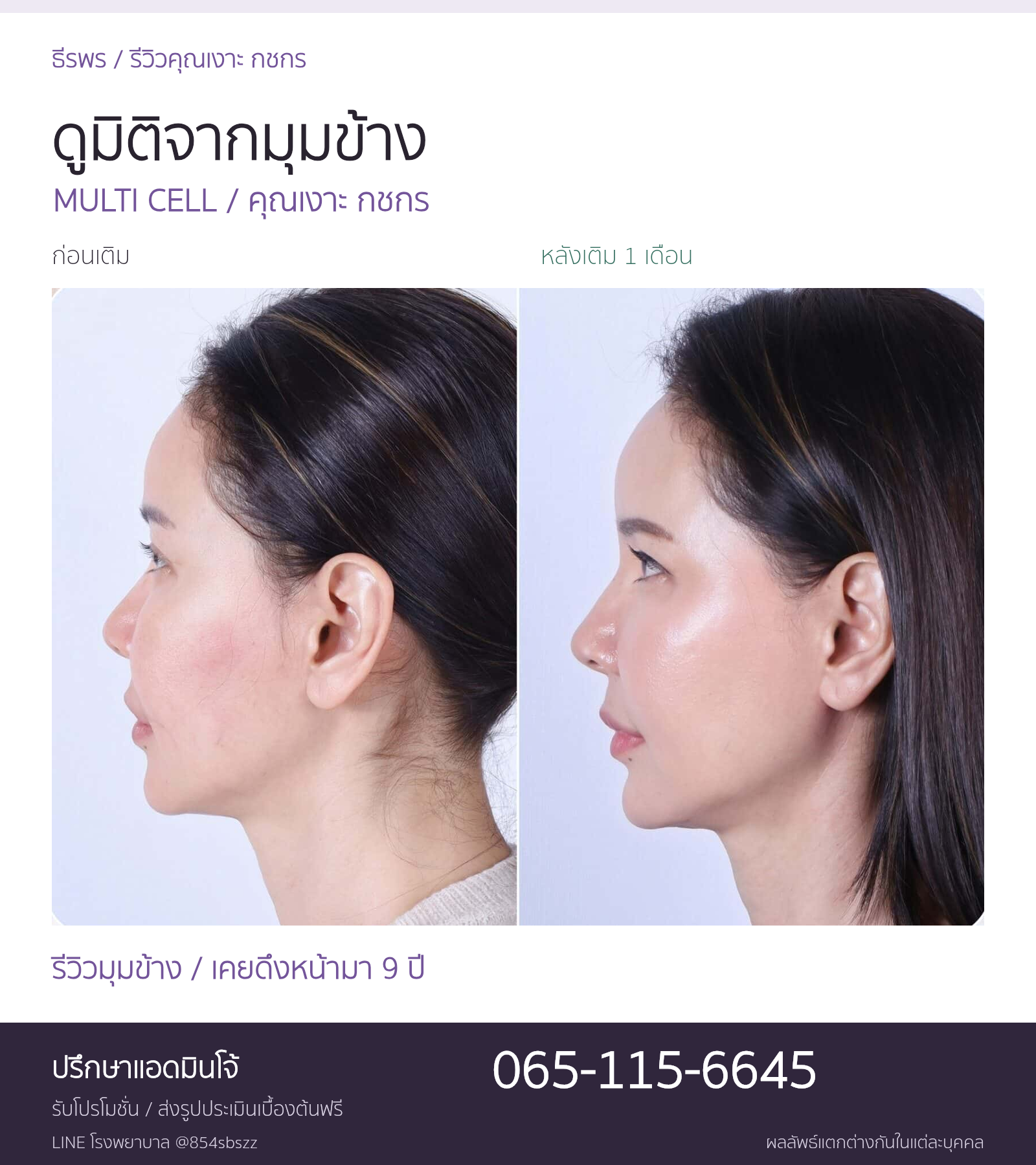 รีวิว Multi Cell คุณเงาะ กชกร ภาพก่อนเติมและหลังเติม 1 เดือน มุมข้างที่ธีรพร