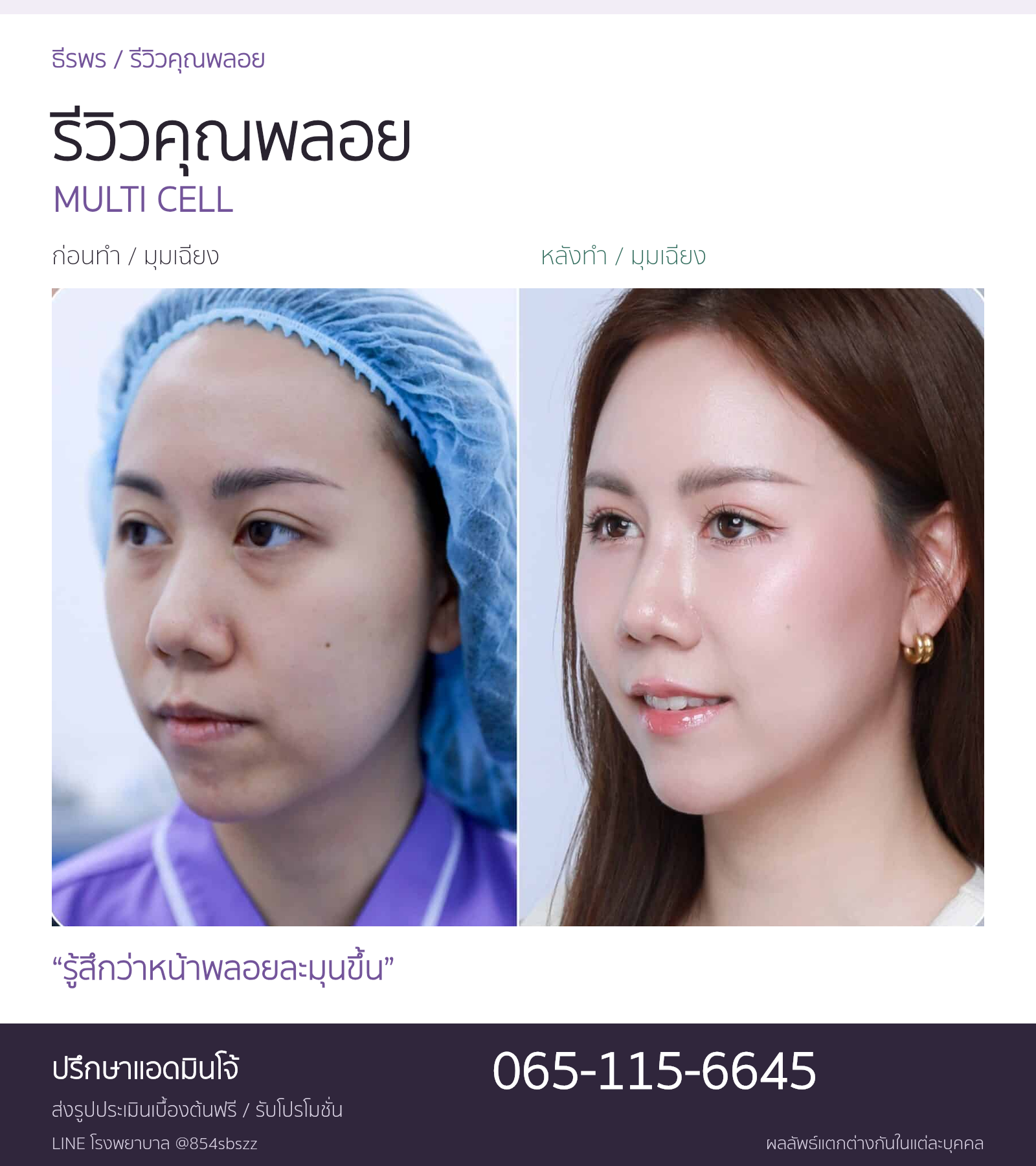 รีวิวมัลติเซลล์คุณพลอย ภาพก่อนและหลังทำ Multi Cell มุมเฉียงที่ธีรพร