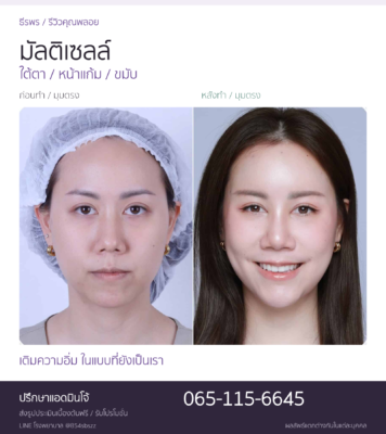 รีวิวมัลติเซลล์คุณพลอย ภาพก่อนหลังมุมตรง เติมใต้ตา หน้าแก้ม และขมับที่ธีรพร