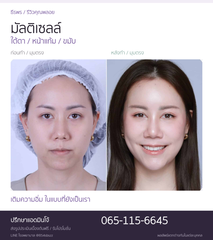 รีวิวมัลติเซลล์คุณพลอย ภาพก่อนหลังมุมตรง เติมใต้ตา หน้าแก้ม และขมับที่ธีรพร