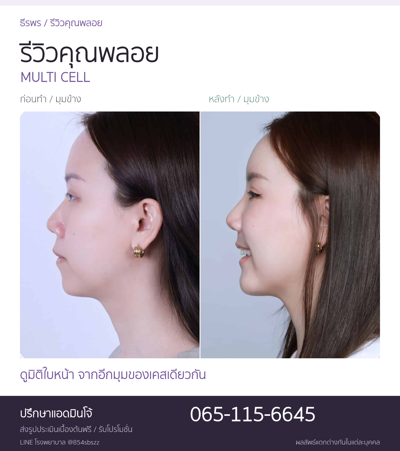 รีวิวมัลติเซลล์คุณพลอย ภาพก่อนและหลังทำ Multi Cell มุมข้างที่ธีรพร