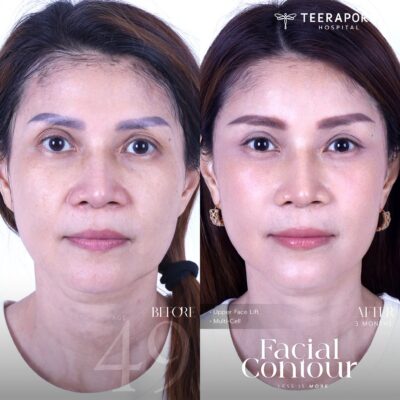 รีวิวดึงหน้าช่วงบน Upper Face Lift ร่วมกับ Multi-Cell ก่อนทำและหลังทำ 3 เดือน จากเพจโรงพยาบาลธีรพร