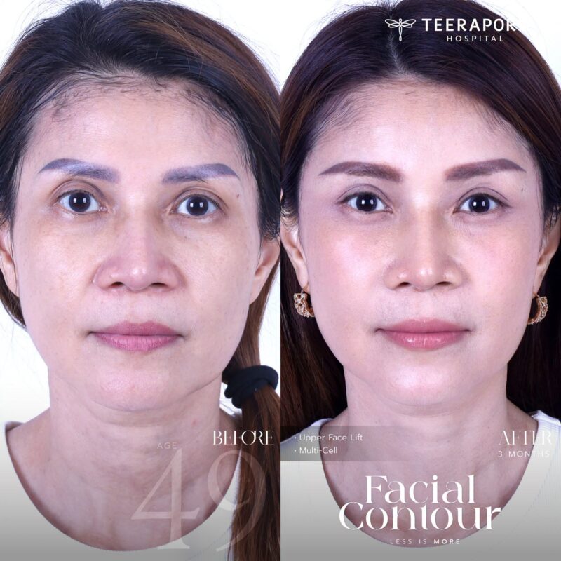 รีวิวดึงหน้าช่วงบน Upper Face Lift ร่วมกับ Multi-Cell ก่อนทำและหลังทำ 3 เดือน จากเพจโรงพยาบาลธีรพร