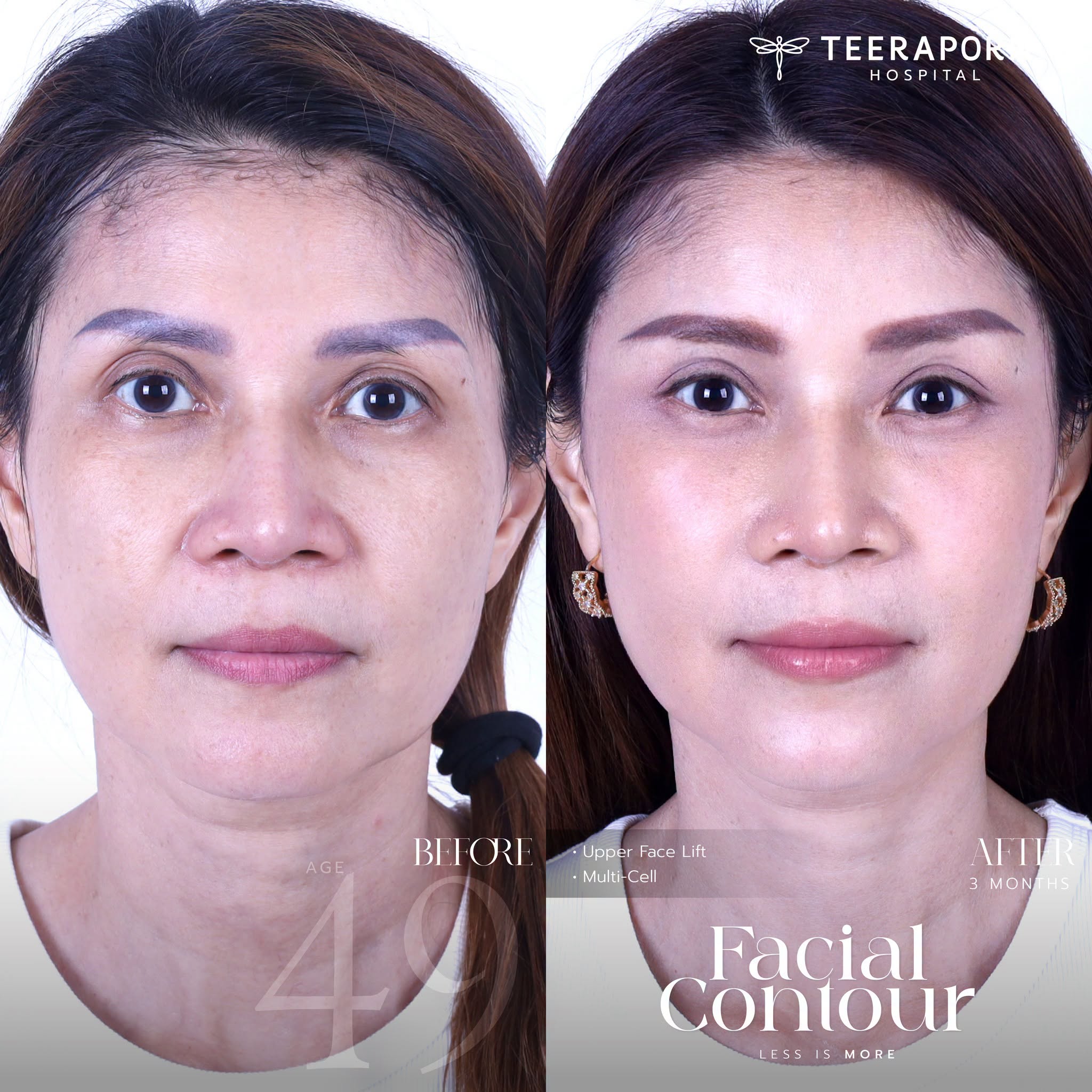 รีวิวดึงหน้าช่วงบน Upper Face Lift ร่วมกับ Multi-Cell ก่อนทำและหลังทำ 3 เดือน จากเพจโรงพยาบาลธีรพร